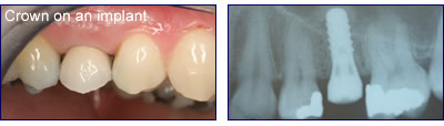 Crown on a dental implant and x ray showing implant in place